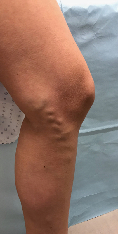 Pre-treatment varicose veins 