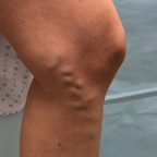 Pre-treatment varicose veins 