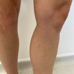 Post-EVLA  and foam sclerotherapy