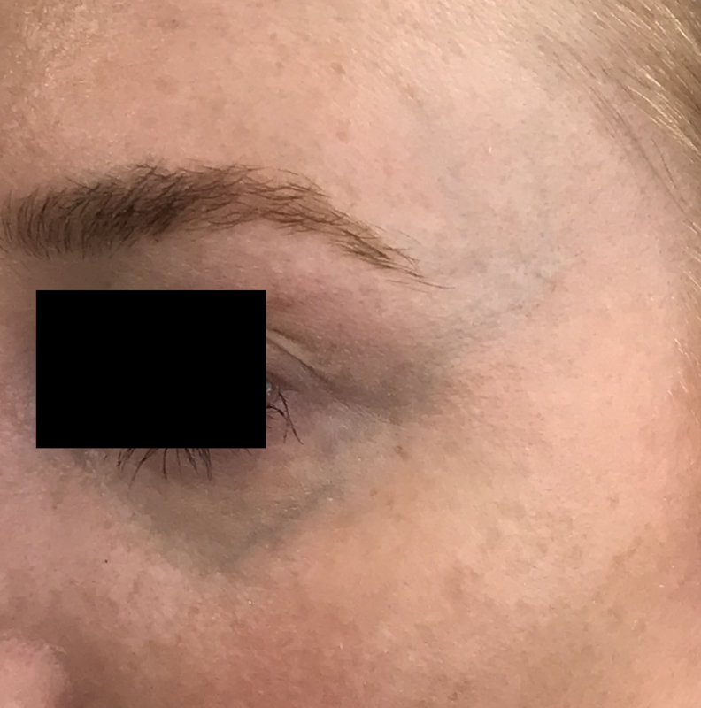 Pre-treatment Facial Veins