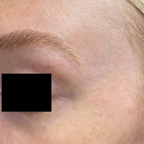 Post-Laser Facial Veins