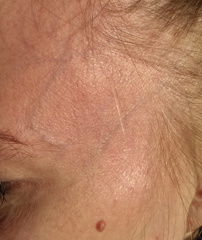 Pre-treatment Facial Veins