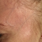 Pre-treatment Facial Veins