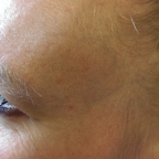 Post-Laser Facial Veins